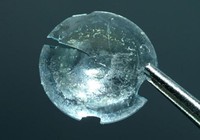 Tìm thấy kính áp tròng thất lạc trong mí mắt sau 28 năm