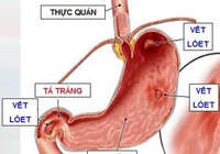 Thuốc nào gây hại dạ dày?