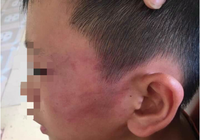 Giám định thương tật cháu bé bị mẹ kế tát bầm tím