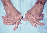 Để không tàn phế do viêm khớp dạng thấp