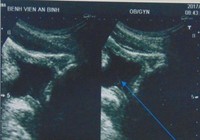 Tự lấy sỏi thận qua đường niệu bằng… cọng cỏ