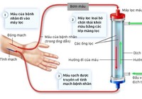 Quá trình chạy thận diễn ra như thế nào?
