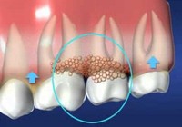 Infographic: 8 cách đơn giản trị sưng viêm nướu răng