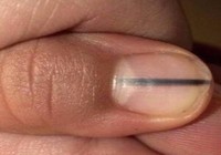 Tưởng chỉ là vết đen trên móng, ai ngờ bệnh chết người
