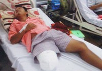 Từ ngã xe, một bệnh nhân đã bị cắt chân