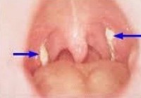 Dịch bệnh bạch hầu lây lan nhanh ở Bình Phước