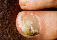 6 mẹo dễ dàng giúp trị bệnh nấm móng