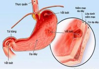 Infographic: 8 món ăn người bị viêm dạ dày cần tránh xa