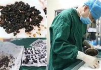 Kinh hoàng phát hiện 200 viên sỏi trong cơ thể