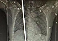 Sống sót kì diệu dù bị thanh sắt 2m đâm xuyên người