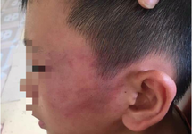 Giám định thương tật cháu bé bị mẹ kế tát bầm tím
