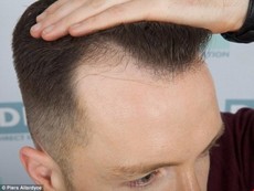 Thủ phạm gây ra chứng hói đầu