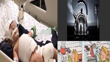 Mắc dây ấm đun siêu tốc, bé 20 tháng tuổi bỏng nặng