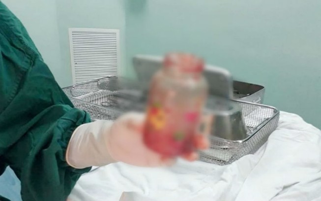 Nhét bình sữa vào hậu môn để... chữa thoái hóa cột sống