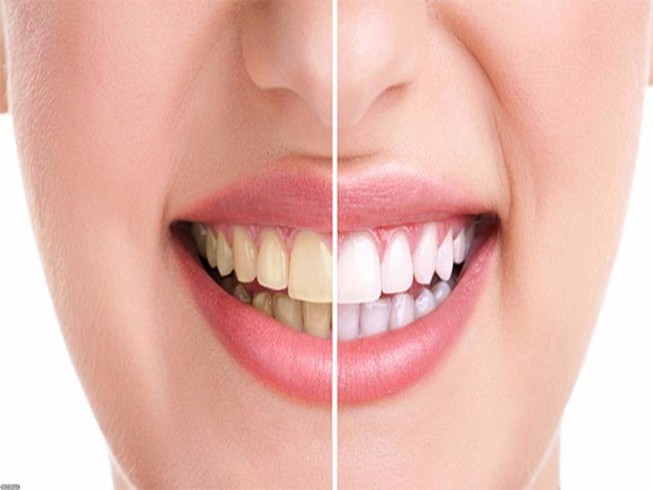 Điểm mặt 6 thủ phạm tàn phá men răng dữ dội nhất