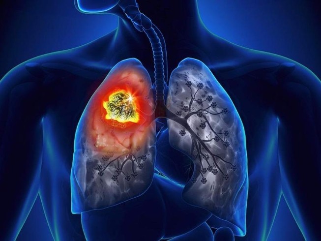 5 bệnh chết chóc ở nam giới thường phát hiện rất trễ