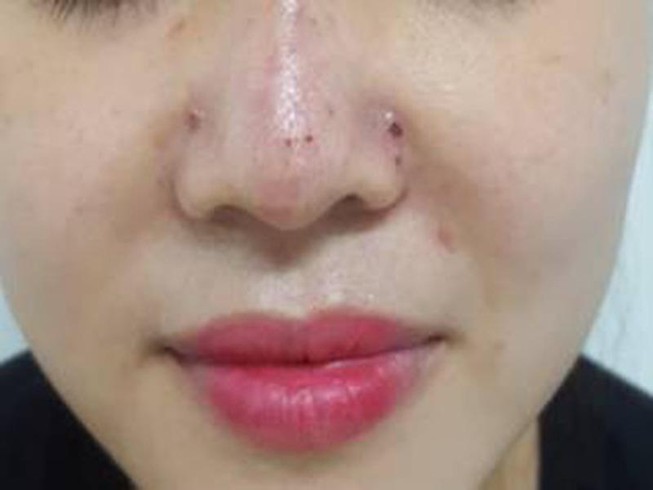 Thêm ca biến chứng sau khi tiêm filler nâng mũi tại spa