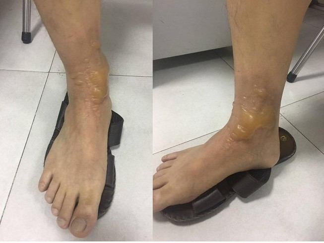 Đi massage, quý ông bị bỏng nặng phải nhập viện