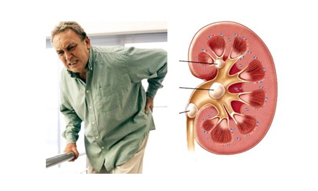 8 thực phẩm càng ăn càng sớm có nguy cơ chạy thận