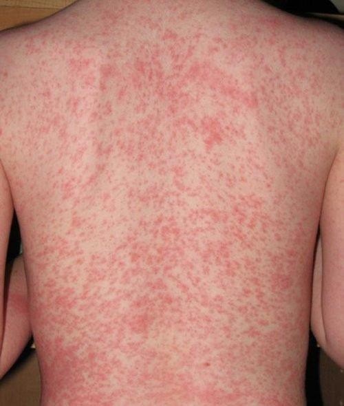 Bệnh sởi đang lan rộng, diễn biến phức tạp tại tỉnh Điện Biên