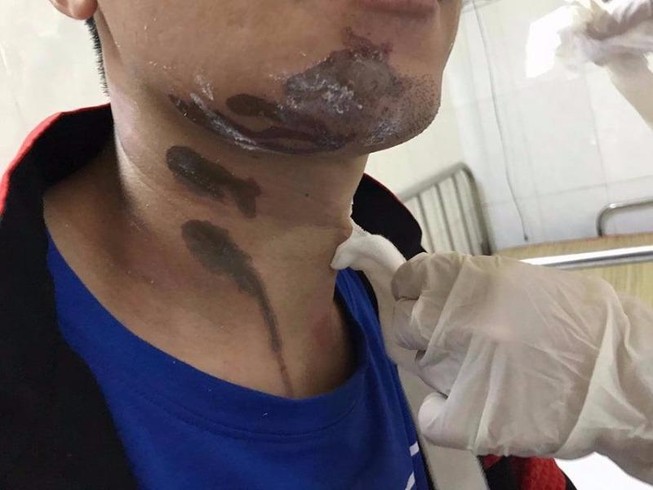 Bỏng nặng vì nước rửa bồn cầu văng trúng người