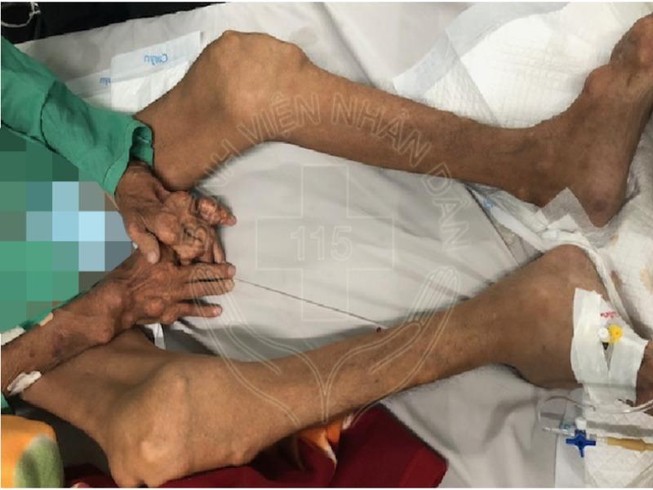 Chân tay biến dạng nặng do tự uống thuốc trị gút