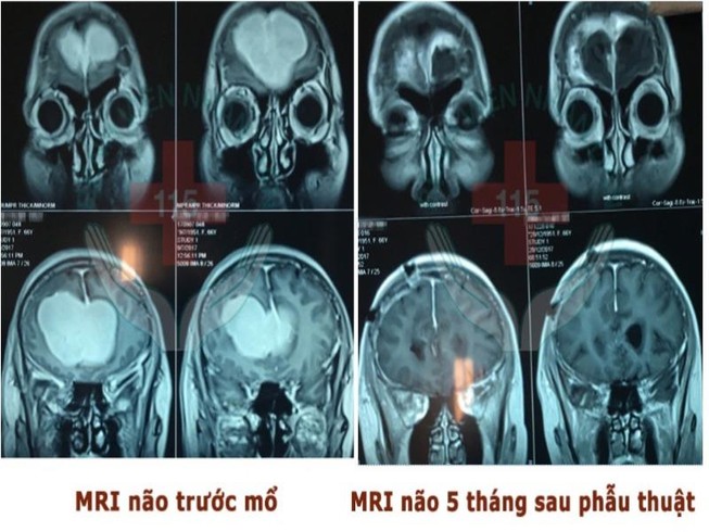 Trầm cảm do u màng não trán