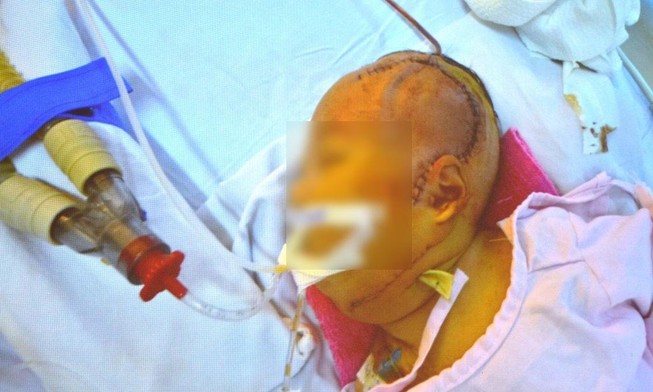 Cứu bé gái 20 ngày tuổi mắc bệnh lạ lần đầu gặp tại VN