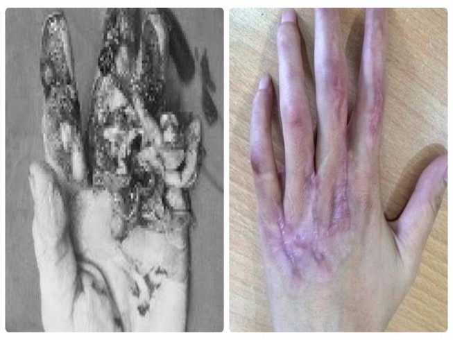 Hồi sinh kỳ diệu bàn tay dập nát cho cô gái trẻ