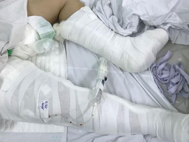 Bé gái 13 tuổi rơi từ lầu 3 chấn thương nặng
