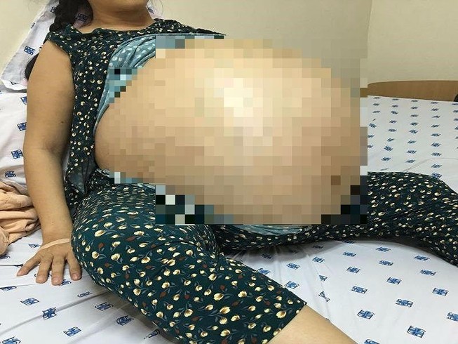 Người phụ nữ mang khối u 50 kg lớn nhất Việt Nam