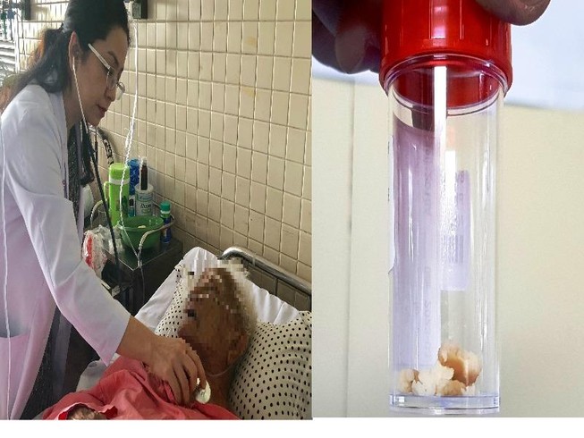 Hi hữu cụ ông gặp nguy vì hóc hạt mít