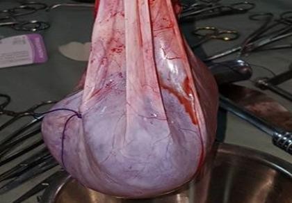 Cụ bà 102 tuổi mang khối u nặng 6 kg nhiều năm