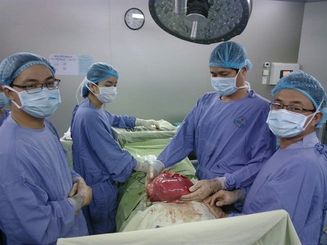 Loại bỏ khối u ‘khổng lồ’ nặng 6,5 kg