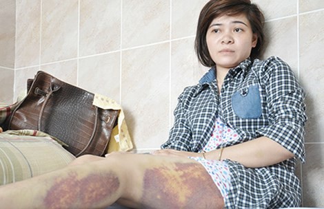Nạn nhân vụ ‘Đánh để truy xét trộm điện thoại’ xuất viện