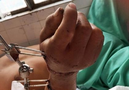 Nối thành công bàn tay gần bị đứt lìa do máy trộn bê tông