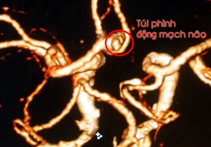Đau đầu kinh niên dễ gặp phình mạch máu não