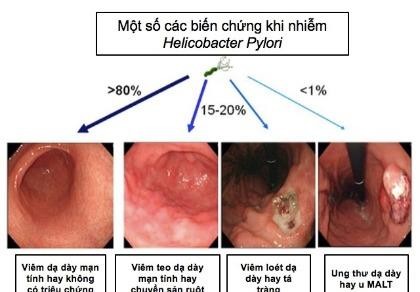 Hơn 70% người trưởng thành ở Việt Nam bị nhiễm HP