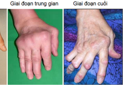 Rước họa do dùng thuốc 'lang vườn' trị viêm khớp