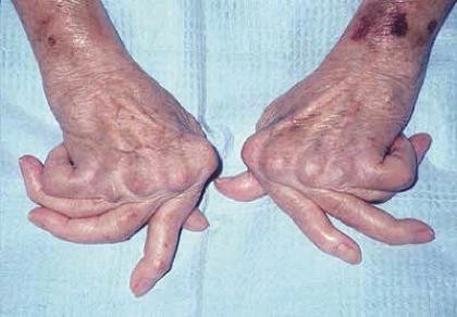 Để không tàn phế do viêm khớp dạng thấp