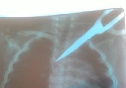 Cấp cứu kịp thời bé gái bị kéo đâm xuyên ngực