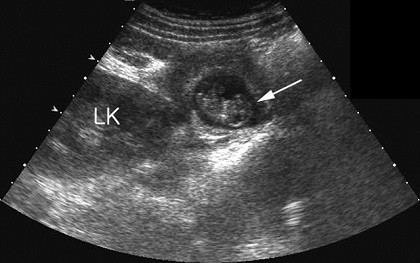 Mổ lấy khối thai ngoài tử cung 'trốn' dưới gan hiếm gặp