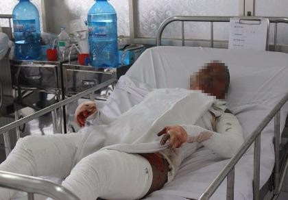 Cô gái bị bỏng nhảy từ lầu 1 xuống đất đang nguy kịch