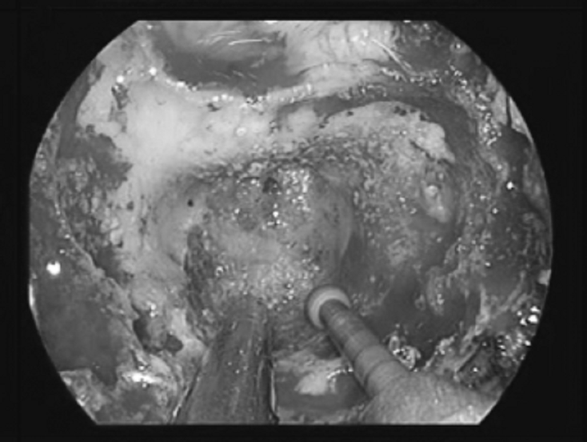 Đau đầu kéo dài, chụp MRI phát hiện u sàn sọ cực hiếm
