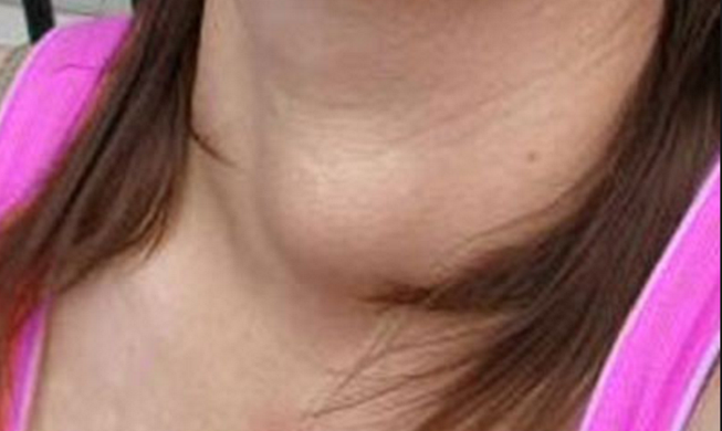 Bướu giáp ở phụ nữ phát triển gấp 5 lần nam giới