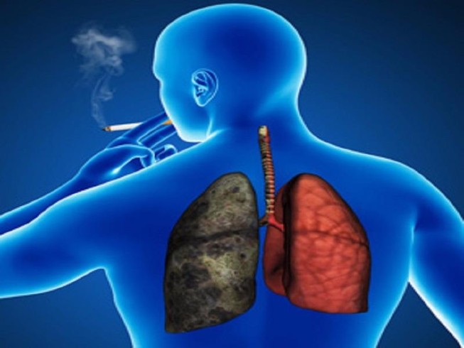 Số người chết do COPD vượt qua số người chết do ung thư