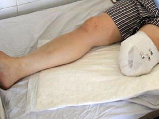 Vụ nhân viên tự cắt chân: Bệnh rất dễ lặp lại