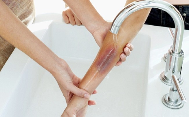 Dội nước đá vào người bỏng vì nổ bốt điện liệu có đúng?