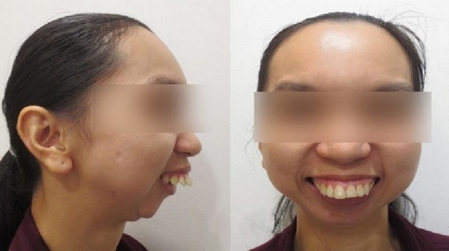 Lần phẫu thuật thứ 46 của cô gái “răng chuột”