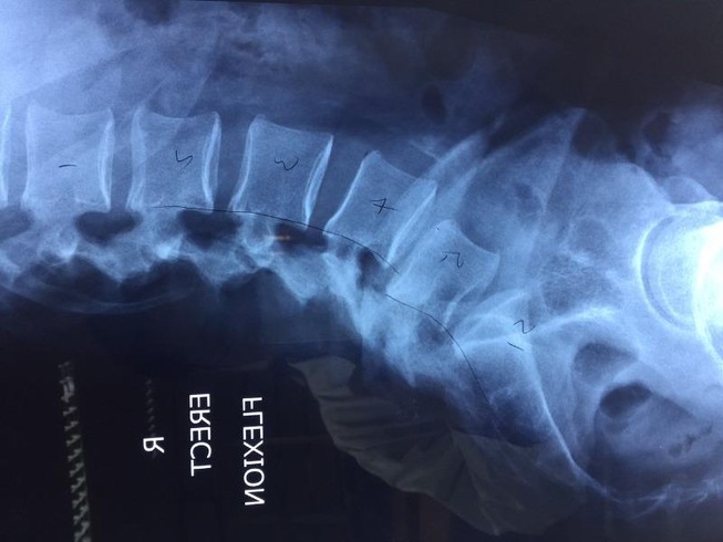Phẫu thuật cột sống cho bệnh nhân nước ngoài